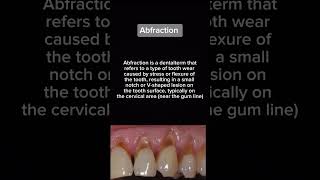 Abfraction  Dental Anomaly  Oral Biology  Dental School [upl. by Larrad132]