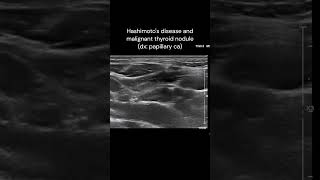 Hashimotos disease amp Papillary Tumor of Thyroid ultrasound cancerawareness thyroid cases [upl. by Moreta]