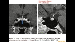 81 Microadenoma anterior pituitary adenohypophysis dynamic MRI hormones prolactinoma [upl. by Gilpin]