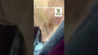 Skin lesion removal [upl. by Leelahk]