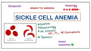 Sickle Cell Anemia  Causes PathophysiologySymptoms Lab Diagnosis amp Treatment pathology robbins [upl. by Adrian]