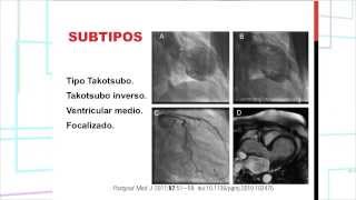 Caso Clínico Síndrome de Takotsubo [upl. by Crotty63]