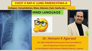 Radiology Chest X Ray4 HINDI Collapse Consolidation Mass AbscessDr Hemant K Agarwal [upl. by Enyrhtak]