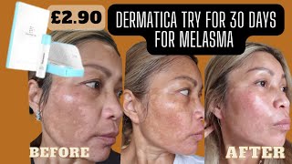 Try new skincare 30 days £290 Dermatica for melasma [upl. by Riggins936]