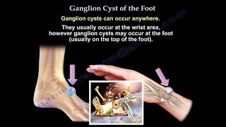 Ganglion Cyst Of The Foot  Everything You Need To Know  Dr Nabil Ebraheim [upl. by Aigneis]