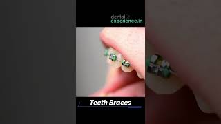 Affordable  Metal braces  Ceramic Teeth Braces  Clear Teeth Aligners Cost in Kochi Kerala India [upl. by Bocyaj]