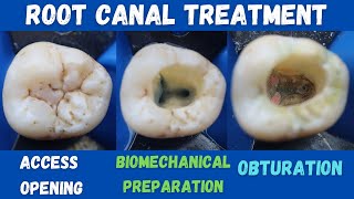 Root Canal Treatment 🔵 Mandibular First Permanent Molar 🟡 access opening ⚪️ BMP 🟣 obturation 🔴 [upl. by Kat416]