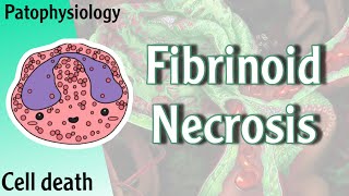 Pathophysiology  Fibrinoid Necrosis Hani Laith شرح [upl. by Enaile488]