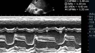 MSRHDGIANT LA WITH SPONTENEOUS ECHOCONTRAST ECHOCARDIO GRAPHY SERIES BY DR ANKUR K CHAUDHARI [upl. by Iad]