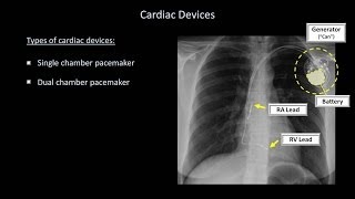 How to Interpret a Chest XRay Lesson 9  Atelectasis Lines Tubes Devices and Surgeries [upl. by Edson]