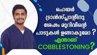 Understanding Donor Area Scars and Cobblestoning in Hair Transplant  La Densitae  Kerala  India [upl. by Oecile]