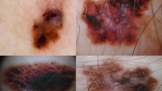 DERMATOSCOPIA DEL MELANOMA EXTENSIVO  Dra Virginia Gonzalez [upl. by Adan]