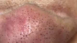 how to get rid of comedones treatment and remove blackheads [upl. by Damaris684]