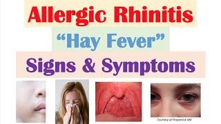 Allergic Rhinitis Hay Fever amp Seasonal Allergies Signs amp Symptoms amp Why They Occur [upl. by Adok]