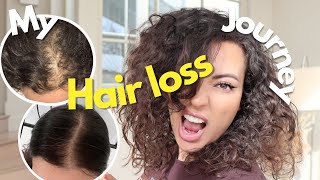 Hair Loss Treatment For Women  My Female Hair Loss Journey  TIPS ON HAIR LOSS [upl. by Tomchay996]