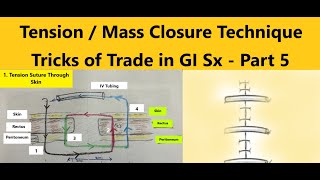 MassTension Closure Technique For Laparotomy Closure Trailer Tricks of Trade in GISx Part 58 [upl. by Thackeray]