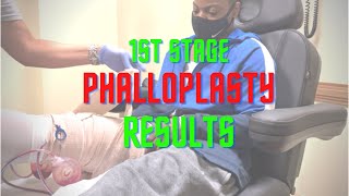 FTM Post Opp Leg Reveal Phalloplasty [upl. by Sheedy803]