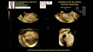 Dermoid Cyst Mature Teratoma [upl. by Ahsaetal572]