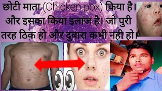 छोटी माता Chicken pox किया है।और इसका किया इलाज है। chickenpox छोटी माता [upl. by Ho232]