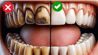 9 Natural Ways To Remove Plaque And Tartar From Your Teeth [upl. by Jarvis242]