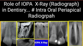 Role of IOPA XRay Radiograph in Dentisry  Intra Oral Periapical Radiogrpah [upl. by Inol]