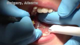 Laser Posterior Tongue Tie Revision in Calgary Alberta [upl. by Erfert]