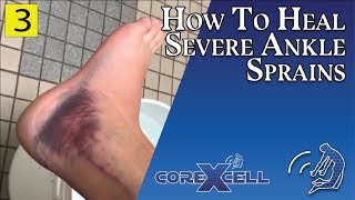 Severe Ankle Sprain  Healed RAPIDLY with Two Techniques  Ep3 [upl. by Ylirama]