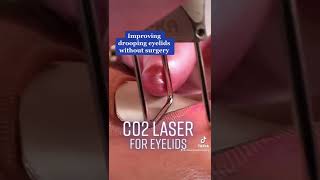 How to Rejuvenate Your Eyes  CO2 Laser Treatment [upl. by Llatsyrc]