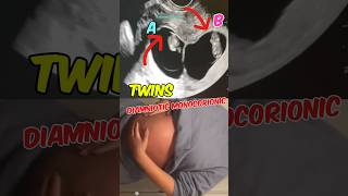 Double joy Twins ultrasound  Diamniotic Monochorionic  Girls pregnancy babyshorts [upl. by Diannne]