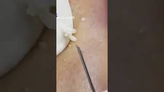 Pickel Ausdrücken Blackheads Mitesser Entfernung 🔴 54 [upl. by Lahtnero960]