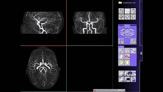 Angiografía Cerebral y Vasos de Cuello [upl. by Alimac]