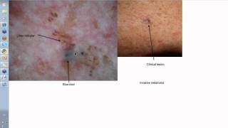 Dermoscopy Made Simple  Melanoma [upl. by Otrevire]