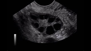 SÍNDROME DE OVARIO POLIQUÍSTICO CAUSAS SÍNTOMAS Y TRATAMIENTO ECOGRAFÍA DE OVARIO SOP [upl. by Gilbertina396]