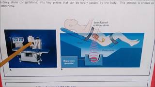 Lithotripsy  Ellipse in medical application [upl. by Letti]