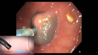 Serrated Polyps of the Colon Part 3 [upl. by Rowney]