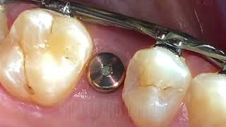 Should I get implant while I am wearing braces [upl. by Asim]