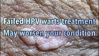 Patient comment after TCA Trichloric acid and Cryo nitrogen treatment of HPV warts made it worse [upl. by Ching844]