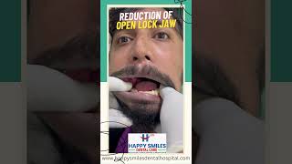 Reduction of open lock Jaw  How to Fix a Locked Jaw  shorts [upl. by Eca]