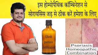 Best Homeopathic Psoriasis Combination  सोरायसिस को हमेशा के लिए ठीक करें  Homeopathic Medicine [upl. by Inalem]