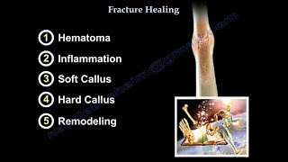 Fracture Healing  Everything You Need To Know  Dr Nabil Ebraheim [upl. by Lossa]