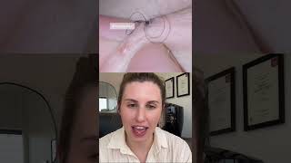 Ingrown Hair So Huge It Could Be Fake…Enjoy [upl. by Ohara]