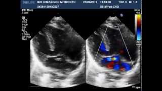 Situs Inversus Mesocardia [upl. by Hannahsohs]