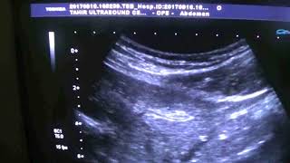 PRIMARY SCLEROSING CHOLANGIITIS with ADENOPATHY [upl. by Seessel]