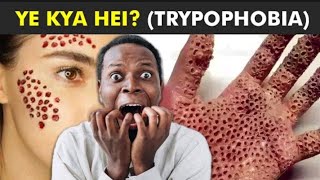 Trypophobia  Fear Of Holes trypophobia fear of holes in skin [upl. by Wini90]