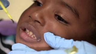 Provider Training Fluoride Varnish HD [upl. by Anelad977]