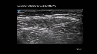 Thigh Ultrasound Lateral Femoral Cutaneous Nerve LFCN Block for Meralgia Parasthetica [upl. by Cinomod]