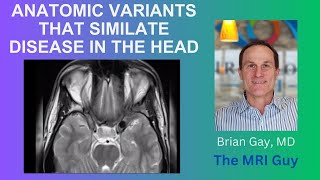 Anatomic variants in the head that simulate disease Part 1 [upl. by Nairam]