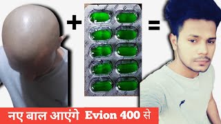 Evion 400 capsule के फायदे EVION 400 VITAMIN E CAPSULE FOR HAIR GROWTH Evion 400 for hairDhru Rao [upl. by Audly]