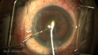 Cataract Surgery Routine Phaco HemiFlip Ike Ahmed 1080pN [upl. by Gitel]