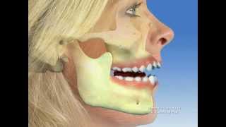 TMJ  Temporomandibular joint dysfunction [upl. by Dalis]